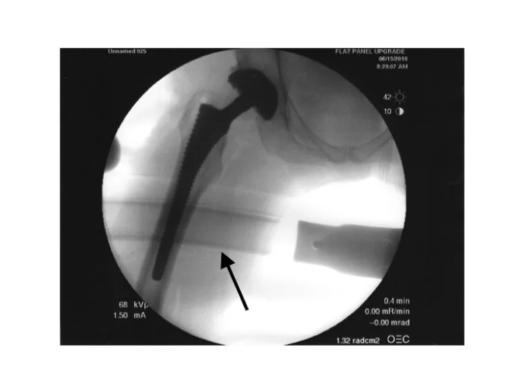 This x-ray shows an image of the hip implant over the radiolucent carbon fiber perineal post sidebar. As you can see, visualization of the implant is not obscured.