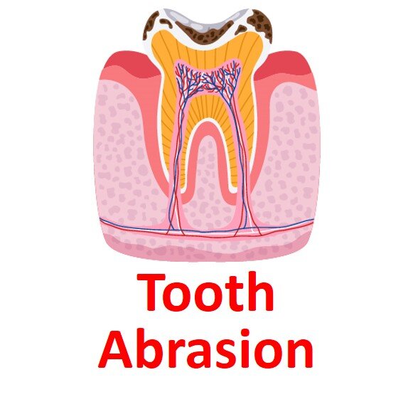 Tooth Abrasion w text.jpg