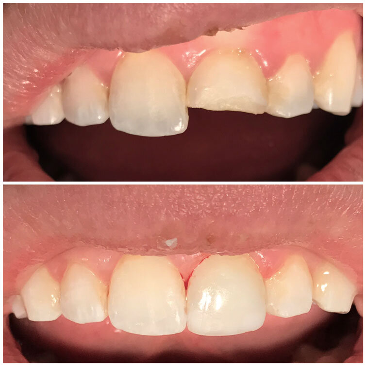 malone-dental-composite-bonding1.jpg
