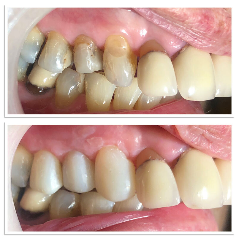 malone-dental-composite-bonding2.jpg