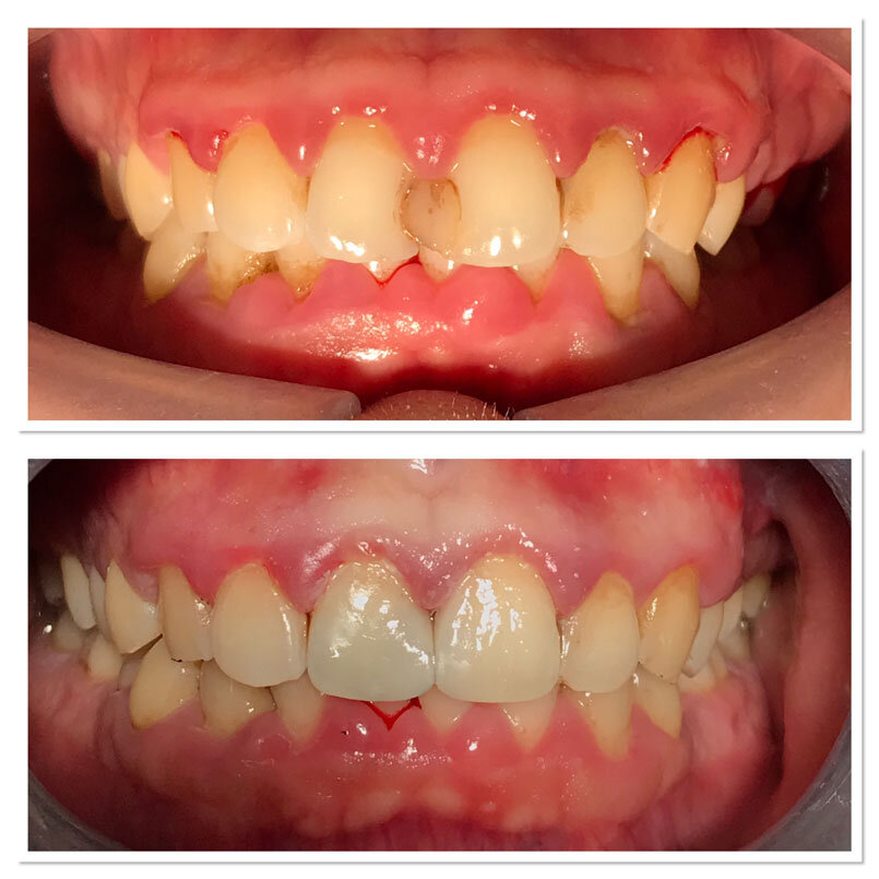 malone-dental-composite-bonding4.jpg