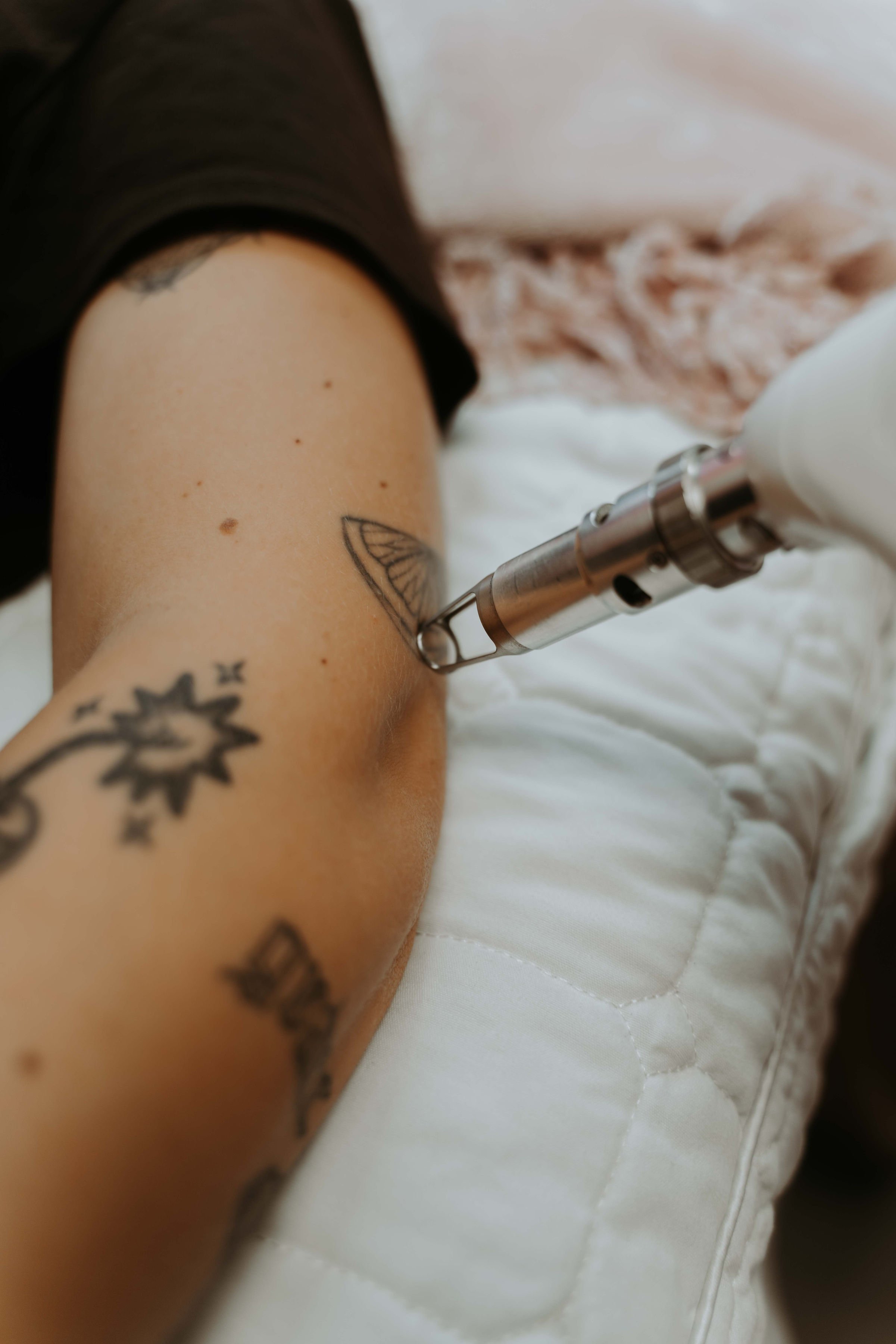 Botched Ink® Saline Tattoo Removal - Needle Depth for Tattoo Removal –  Botched Ink UK