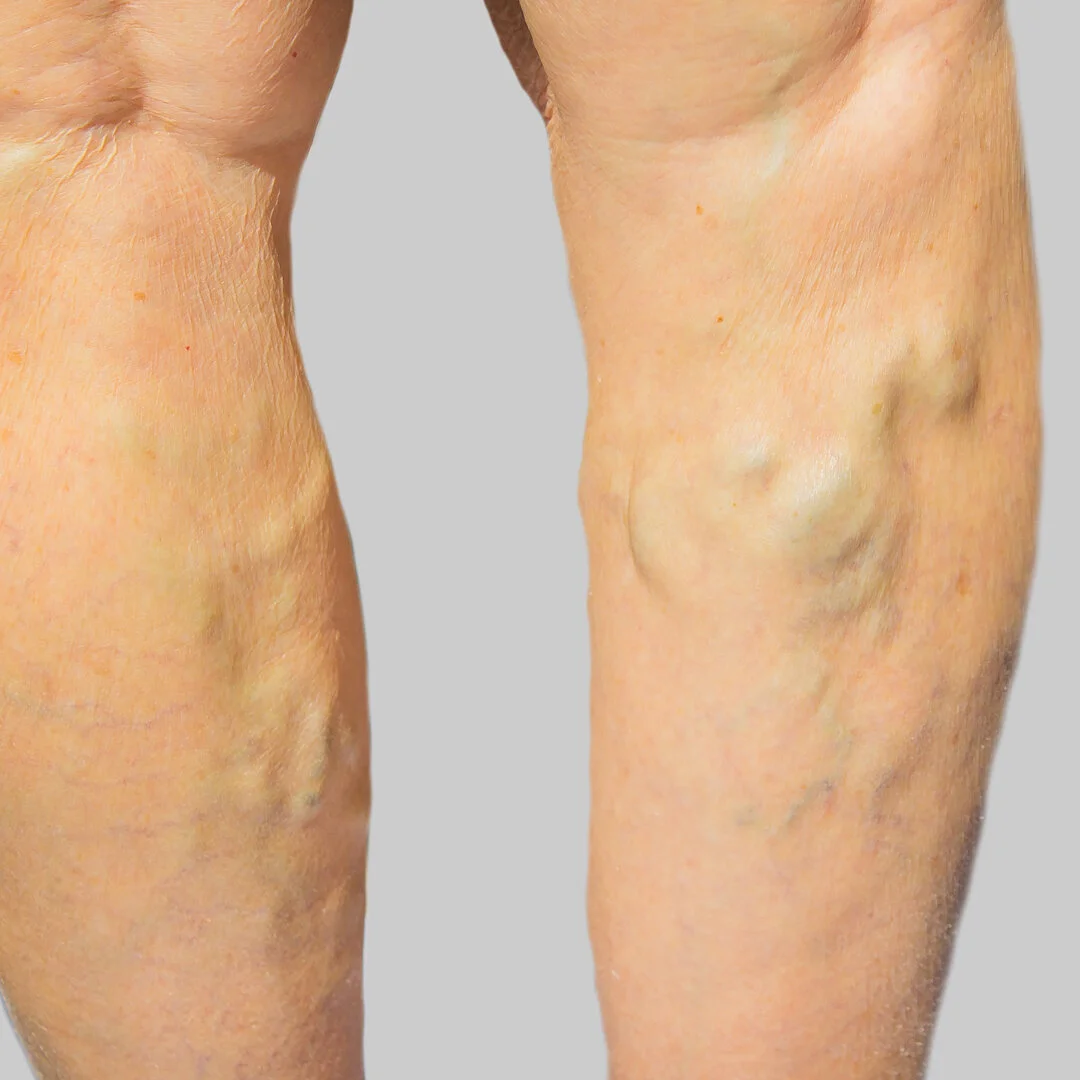 varicoseveins.jpg