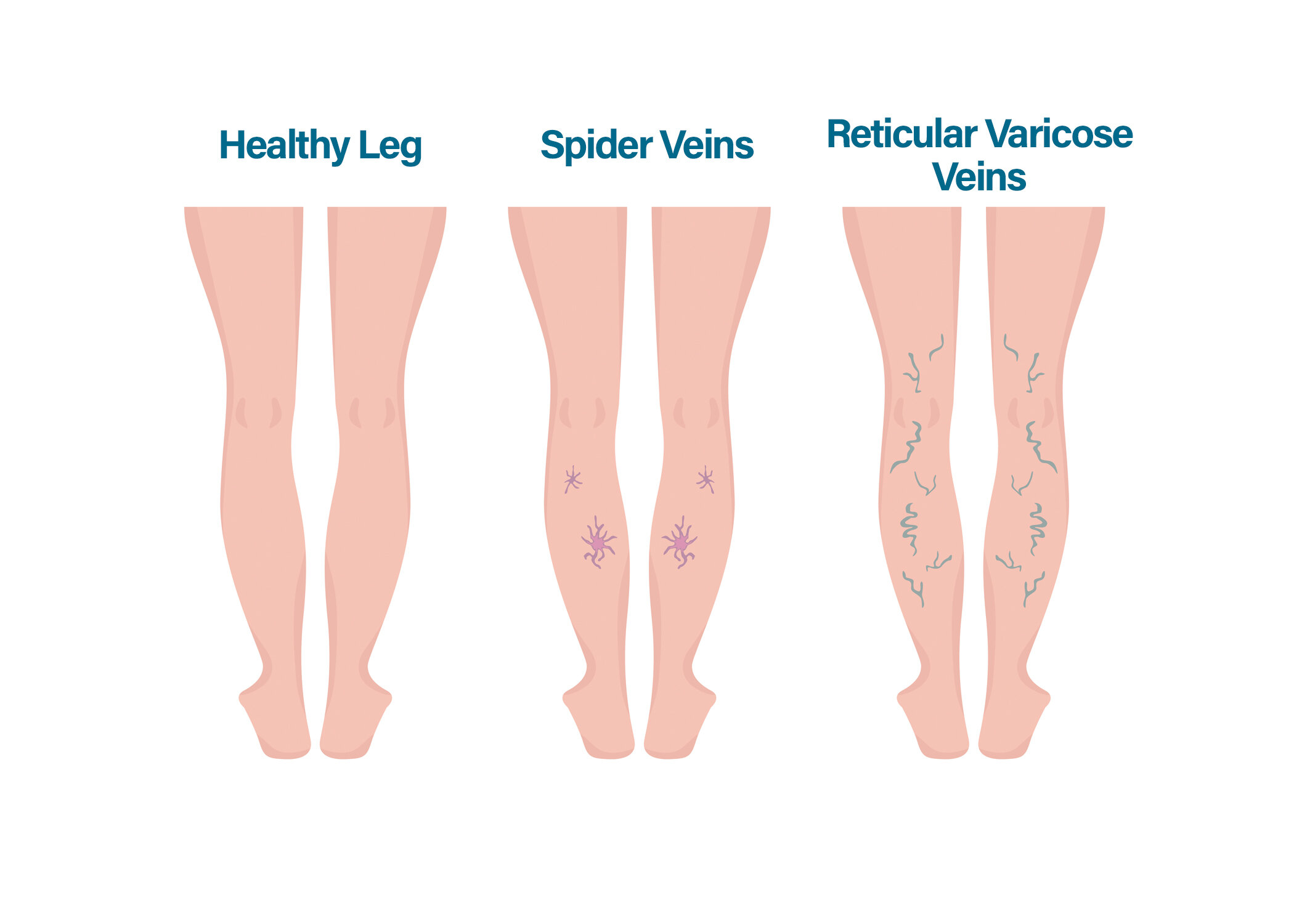 Varicose Veins: Symptoms and Treatment Options — Physicians Vein Clinics