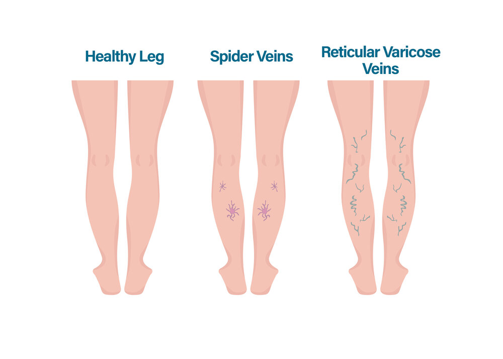 Remedii naturiste în bolile picioarelor dureroase