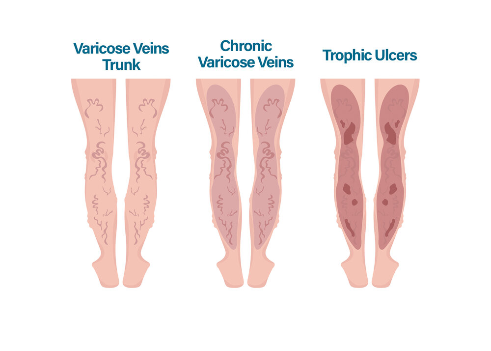 varicose veins causes