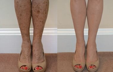 Aging Spots on Legs: What's Normal, What's Not