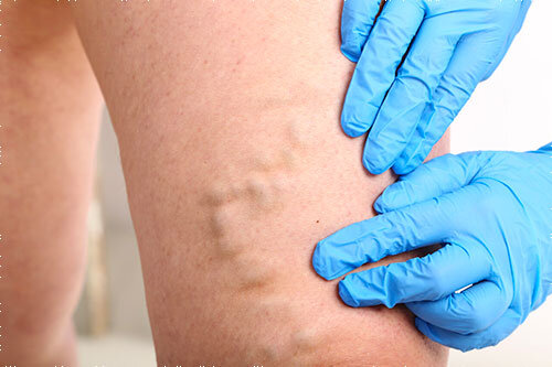 varicoza cheaguri de sânge în tratamentul picioarelor cum sa tratai picioarele i vene varicoase