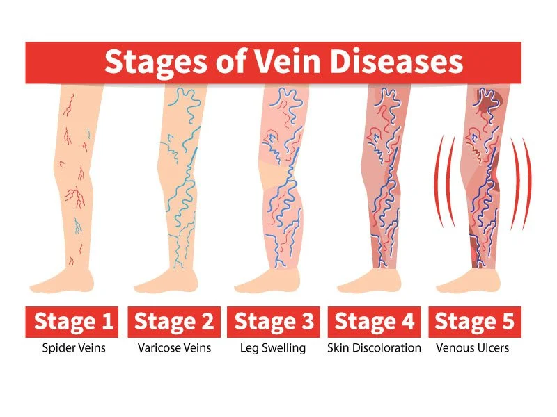 The Stages of Vein Disease