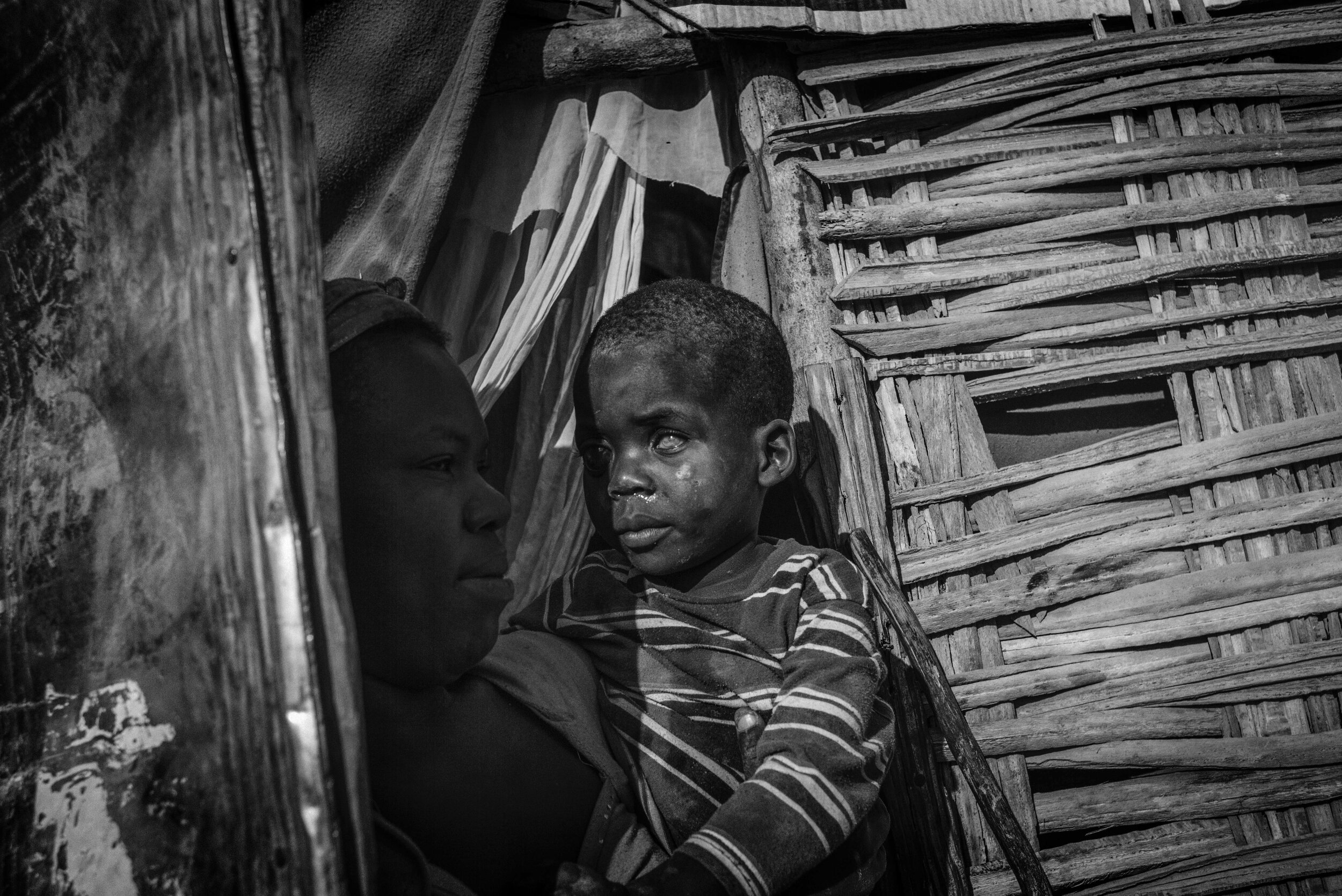  Photo of baby with milky eyes from cataract disease 