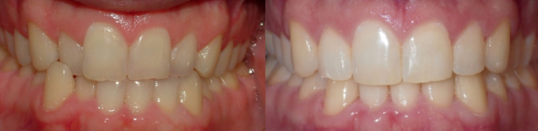 Invisalign-Before-After-4.jpg