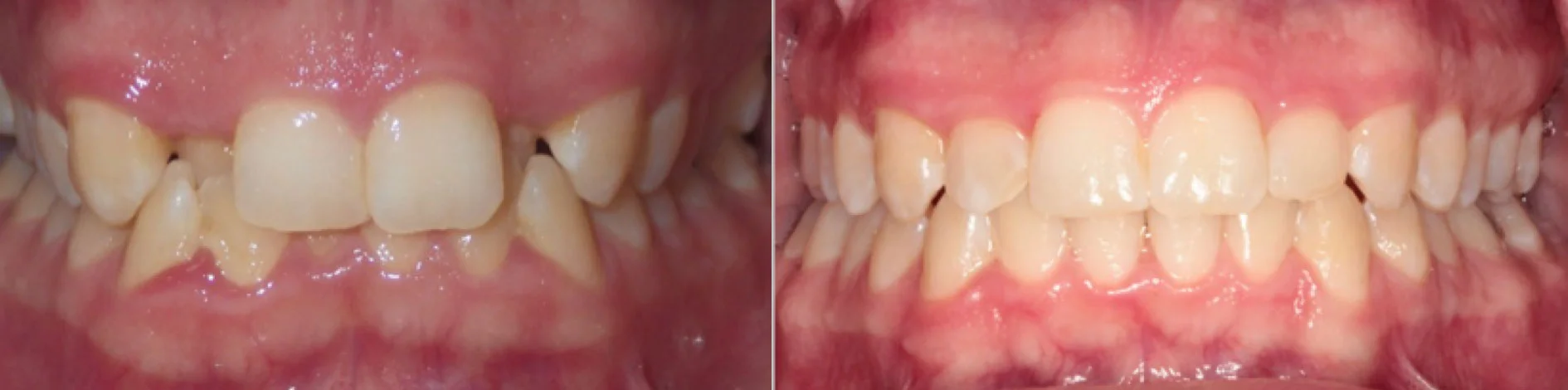 Invisalign-Before-After-5.jpg