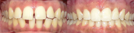 Invisalign-Before-After-6.jpg