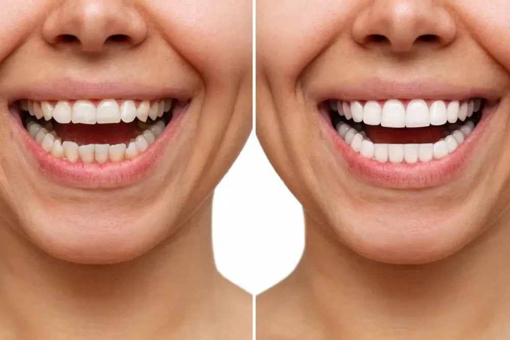 before-after-teeth-whitening.webp