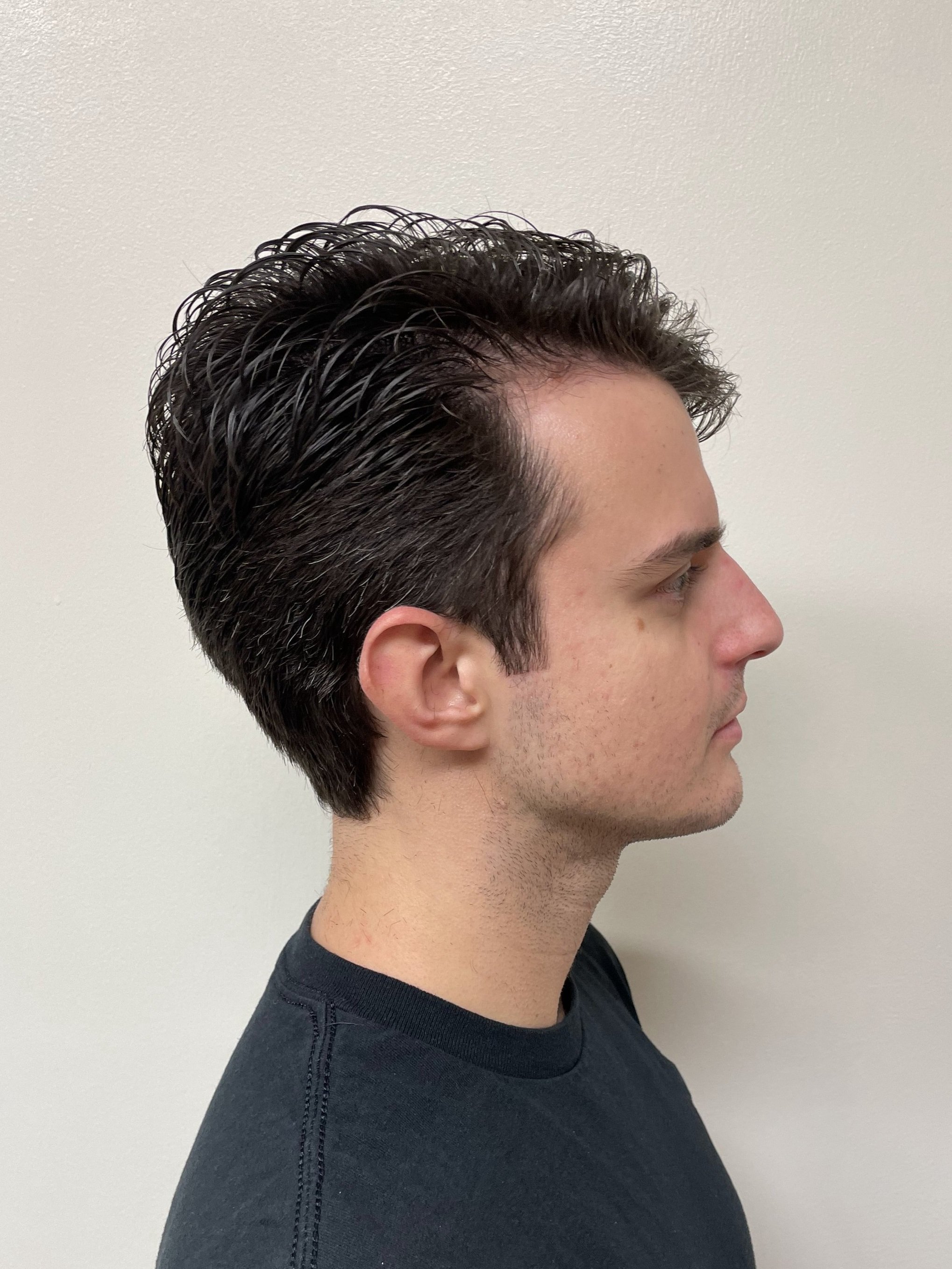 Finished look on client, opposite side view