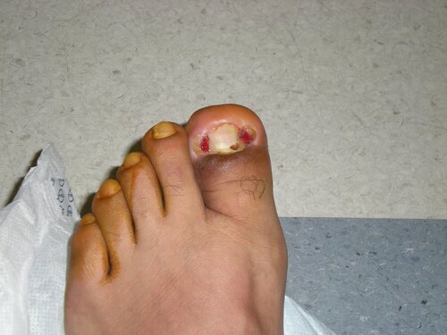 Ingrown Toenails.jpeg