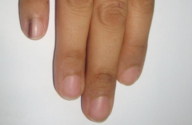 Black streaks on nails — SKIN360CLINIC