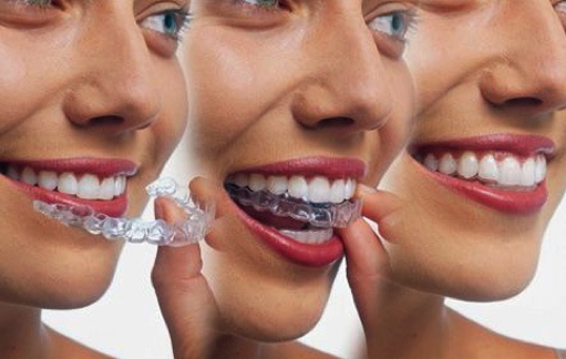 invisalign2.png
