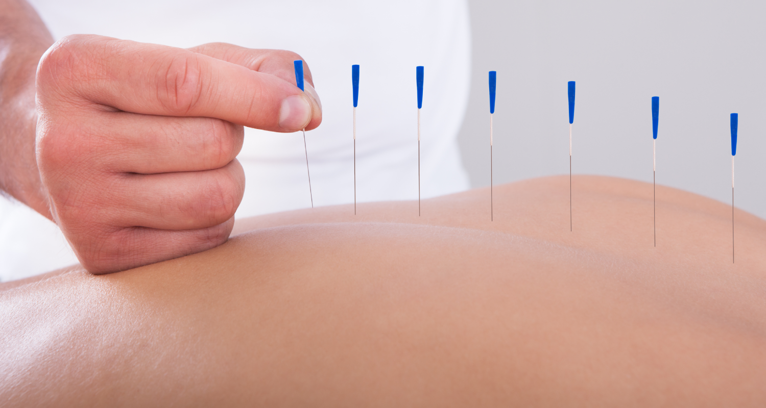 acupunture.png