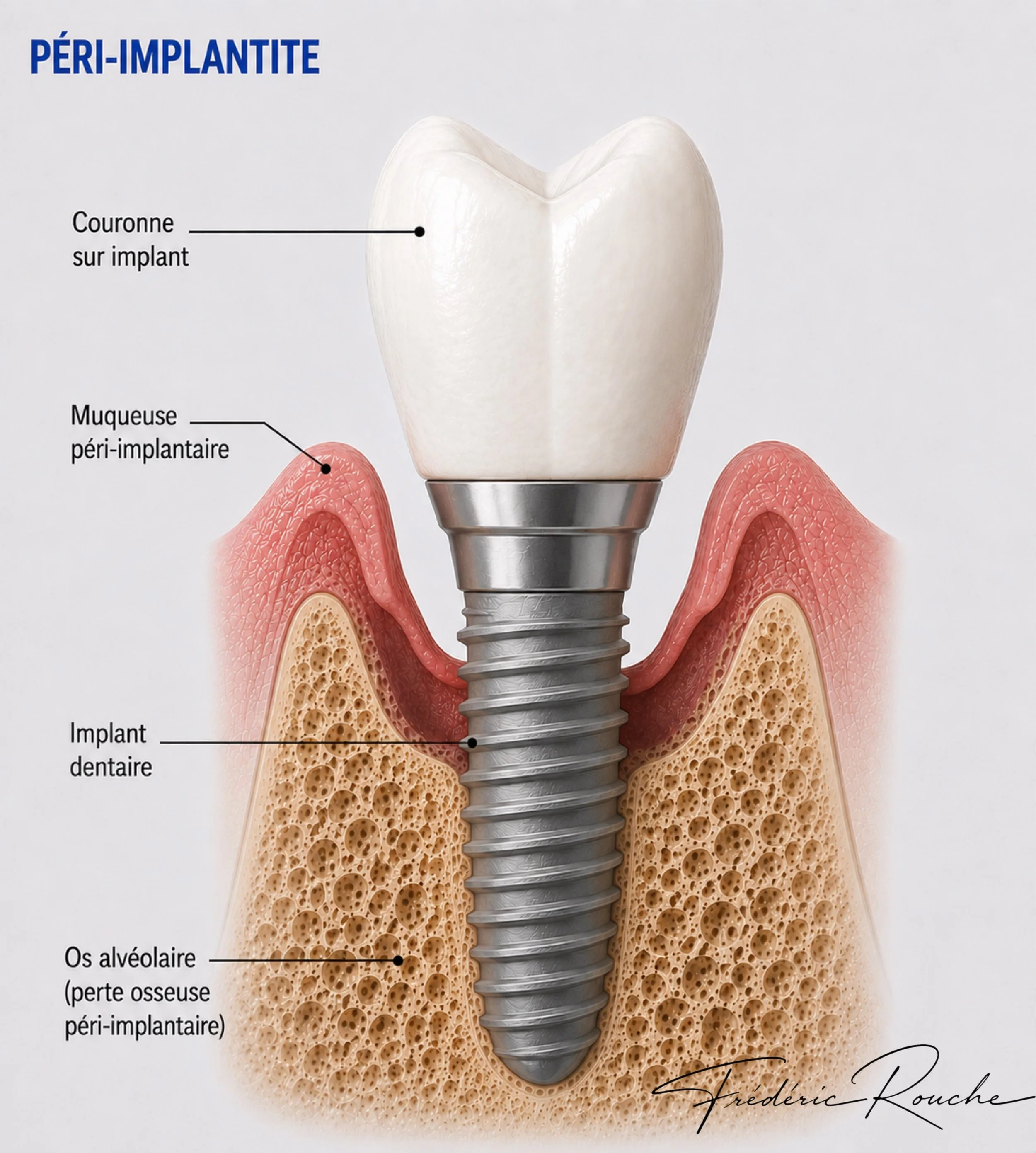 docteur rouche parodontiste peri-implantite.jpg