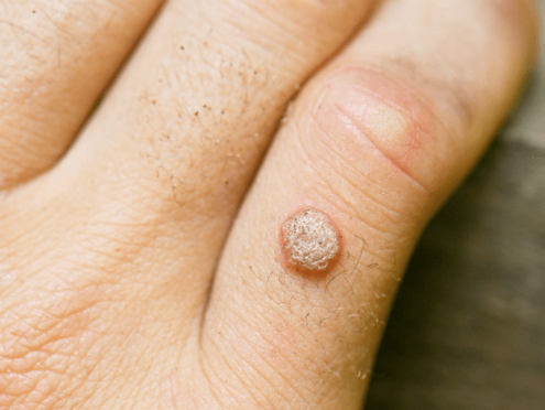 Wart skin lump What causes a wart virus