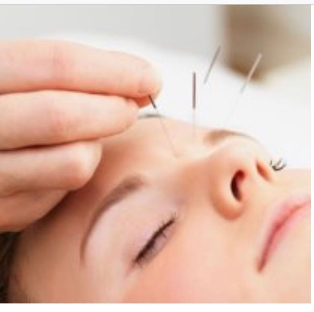 Suffering from the dreaded West Texas allergies or constant sinus congestion from the winter cold? Acupuncture works great to clear out the sinuses and reduce allergy symptoms. Get ahead of those spring blooms! #acupuncture #allergies #holistichealth #wellness
