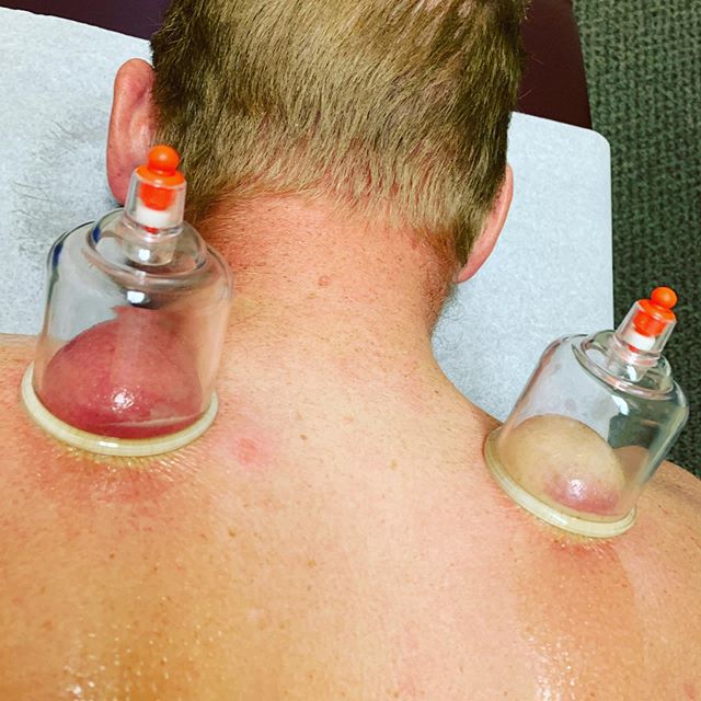 A little cupping action to release the levators. Can you guess which side had been injured and more bothersome? .
.
.
Dark red/purple blood pooling with the cups is a sign of stagnant blood flow due to injury or Chi (energy) imbalance. @belindajodc #