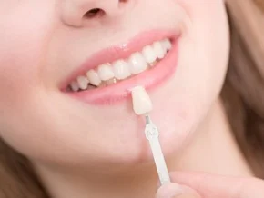 veneers.jpg