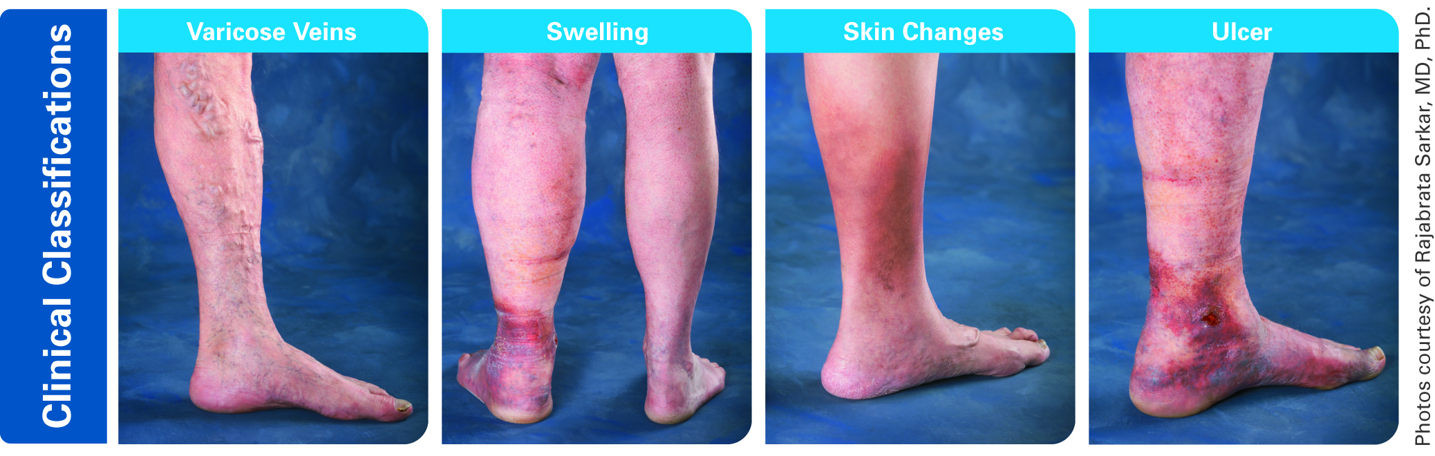 Chronic Venous Insufficiency — Dr Lee