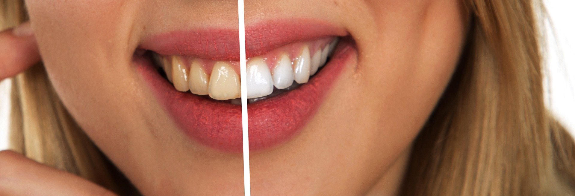 kraan Berri gemak U wilt een stralend en wit gebit? Tanden bleken in Nijkerk? — NijCare  Tandartspraktijk