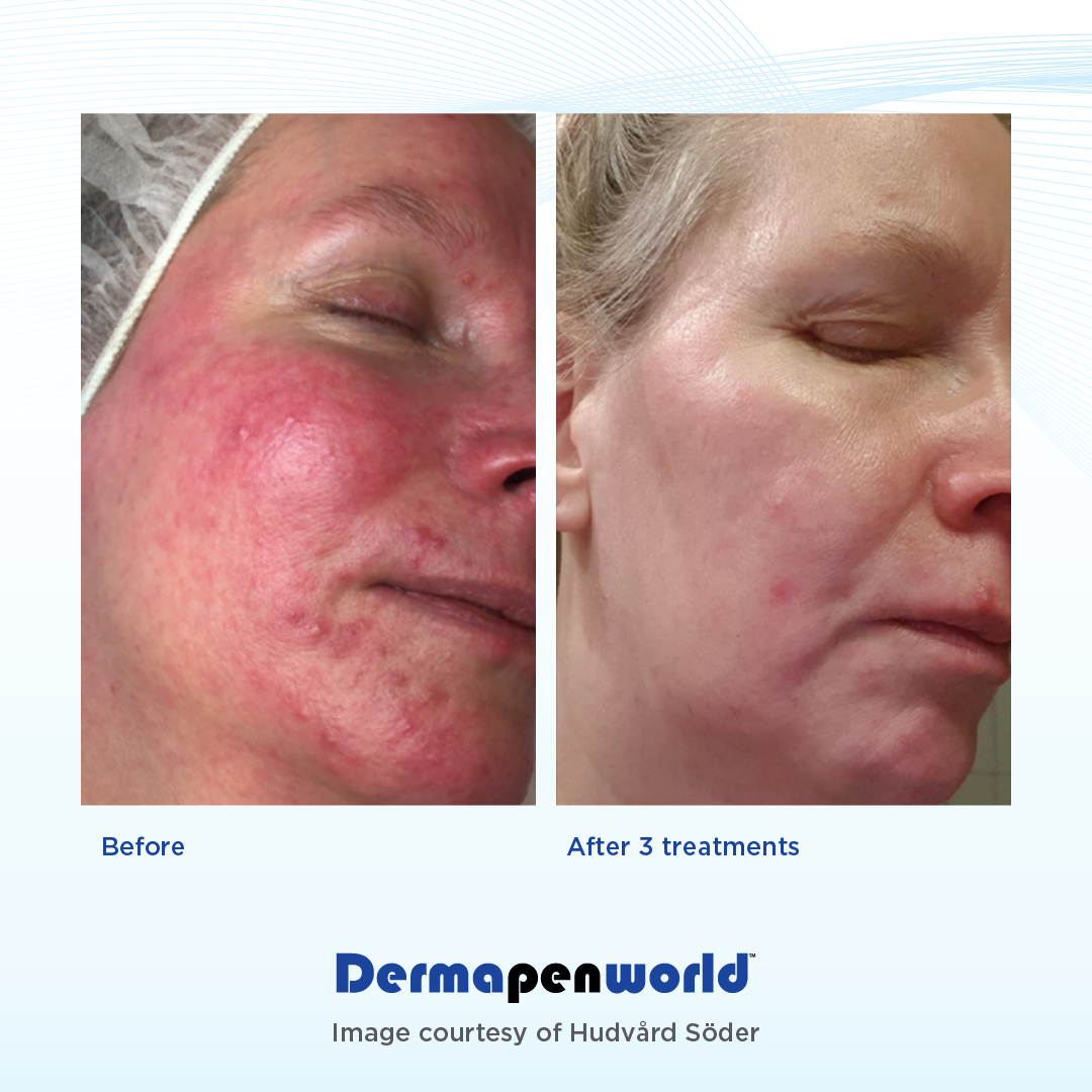 Dermapen-Before-and-After-Rosacea.png