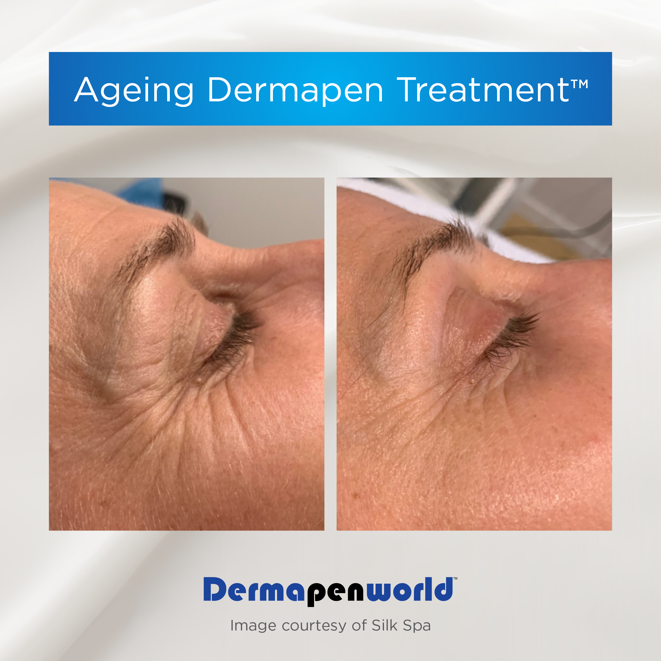 Dermapen-Wrinkles-Before-and-After.png