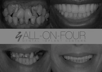 All-On-4 Dental Implants - Your Questions Answered