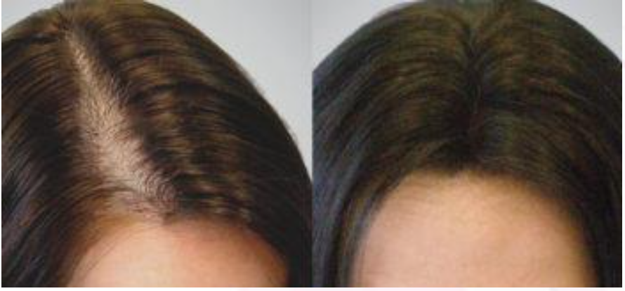 PRP/PRF, hair loss treatment and skin rejuvenation — Aesthetics
