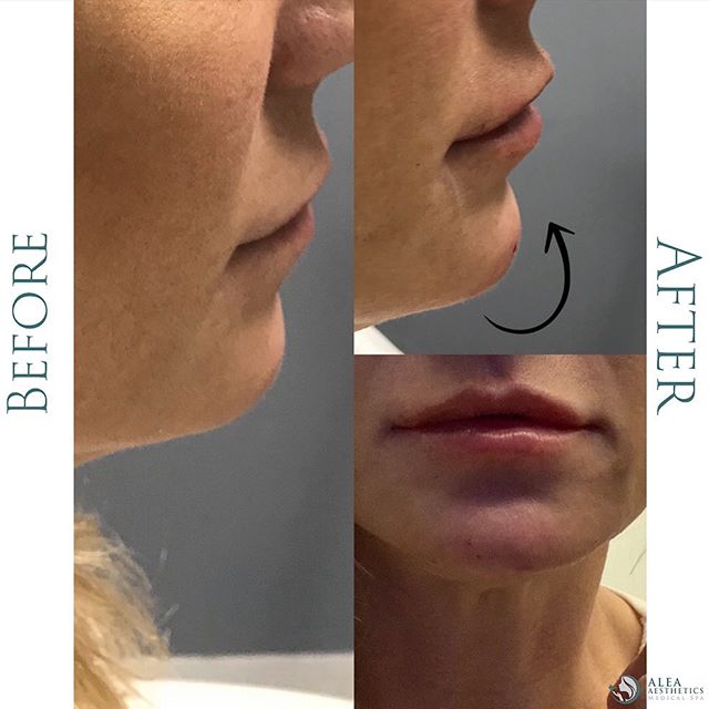 Slight chin augmentation @alea_medspa using 1.0cc of #juvederm . .
.
.
DM for more info or call 1-833-999-2532 if you have any questions. 💌
.
.
.
 #fillers #nonsurgical #botox #dermalfillers #injectables #glowup #skin #beauty #gorgeous #aleamedspa #