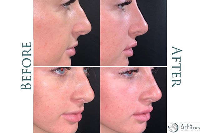 Our beautiful client felt a little insecure about her nose and so we performed a non-surgical rhinoplasty @alea_medspa using 1 syringe of #juvederm Ultra Plus XC and 0.5ml of filler for the upper lip. .
.
.
DM for more info or call 1-833-999-2532 if 