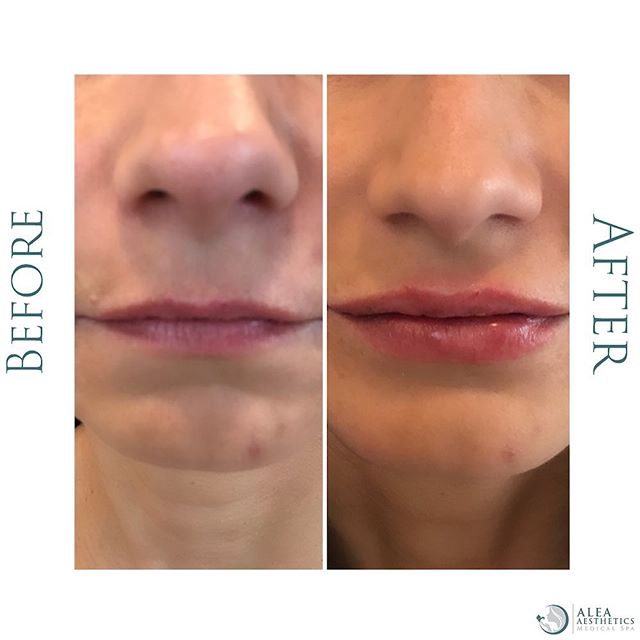 #throwbackthursday from @alea_medspa. Subtle lip enhancement 👄 .
.
.
DM for more info or call 1-833-999-2532 if you have any questions. 💌
.
.
.
 #fillers #nonsurgical #botox #dermalfillers #injectables #glowup #skin #beauty #gorgeous #aleamedspa #p