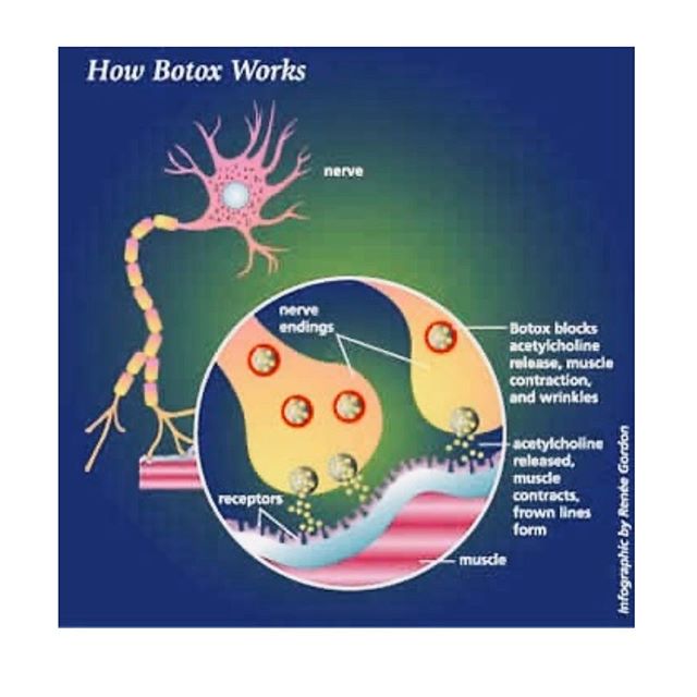 How botox works 🤔Please note that the infographic is not ours and was done by Renee Gordon. The common anti-wrinkle treatments that you hear about such as #botox or #dysport are from the Botulinum toxin family. Botulinum toxin blocks Acetylcholine r