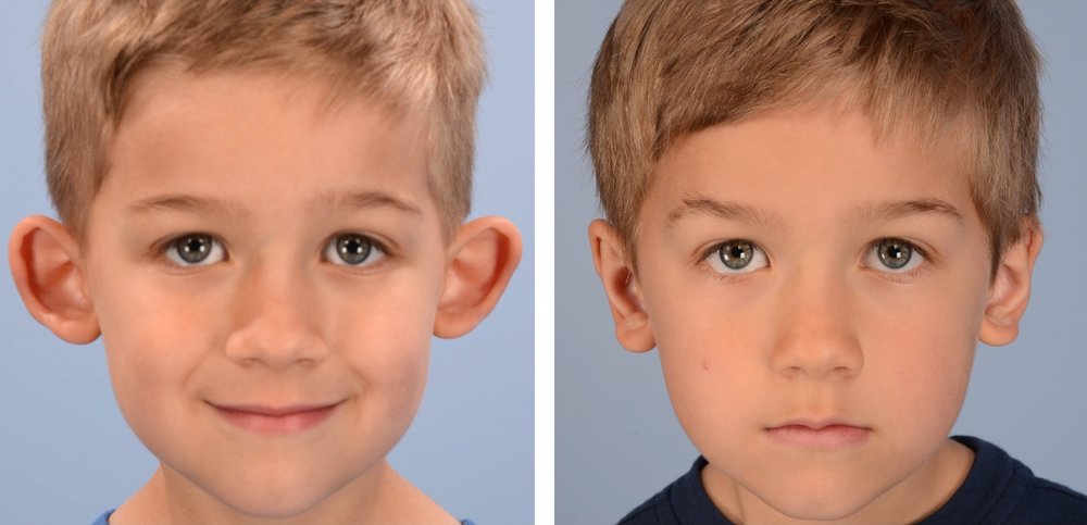 What is Otoplasty? Christopher Derderian, MD Microtia Surgeon