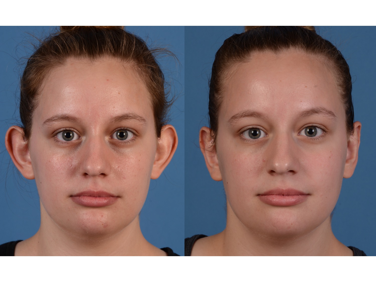 Otoplasty Cost One Ear 2025