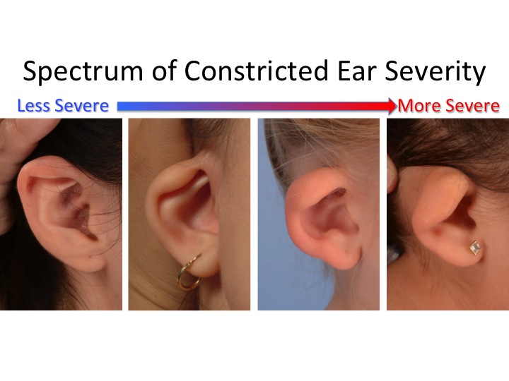 Constricted Ear (Lop Ear) Deformity 