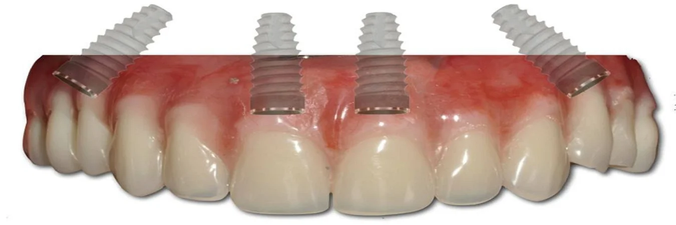 All-On-4-Dental-Implants-Dental-Clinic.jpg