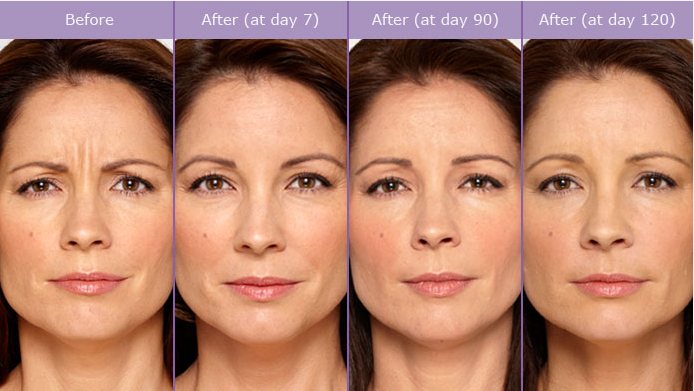 SCG-Skin-Before-After-from-Botox-Alecia.png