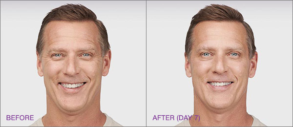 botox-male-before-and-after.jpg