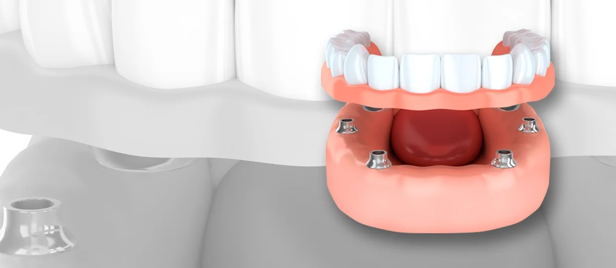 Tired of Dentures? — S3 Dental Hinchley Wood Private & NHS Dentistry