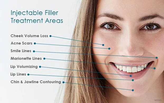 injectable_filler_treatement_areas.jpg
