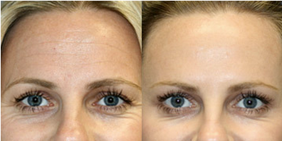 Botox-Before-and-After.png
