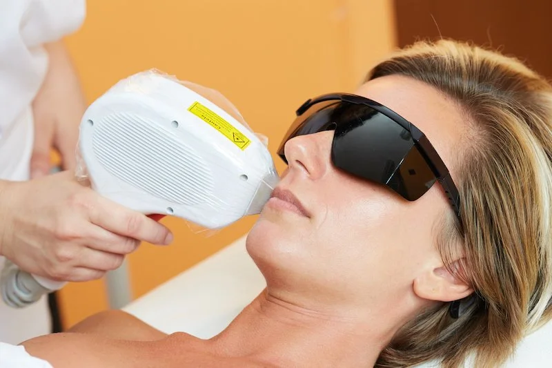 Radiant Skin RN - laser hair removal lip.jpeg