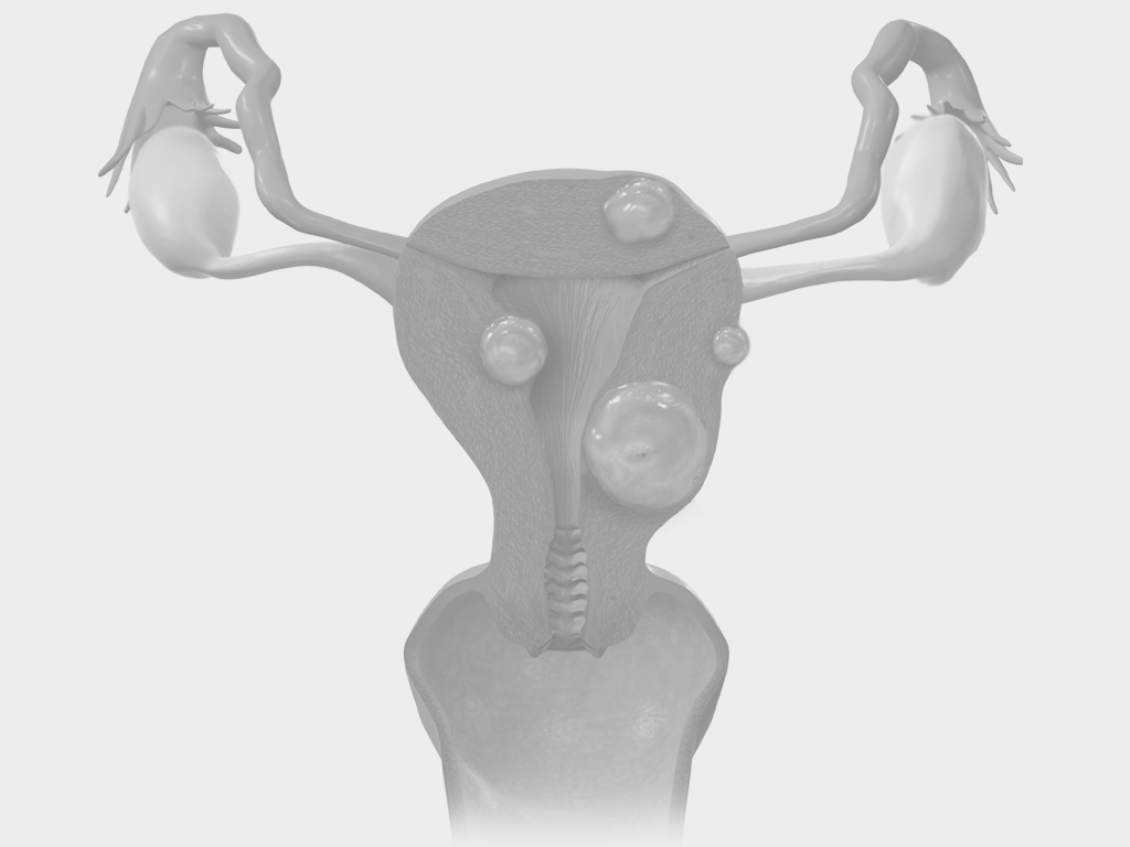 Utero com miomas.png