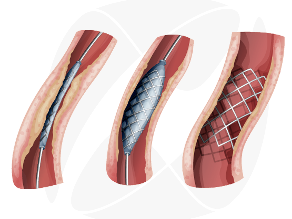 Angioplastia.png